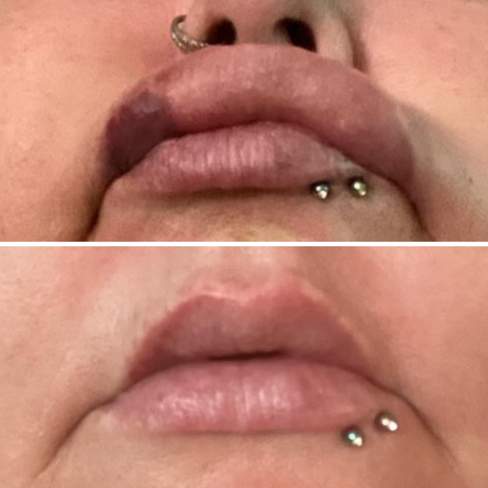 AfterMED LIPS