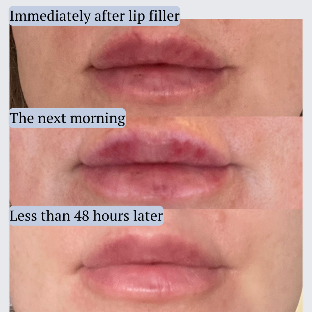 AfterMED LIPS